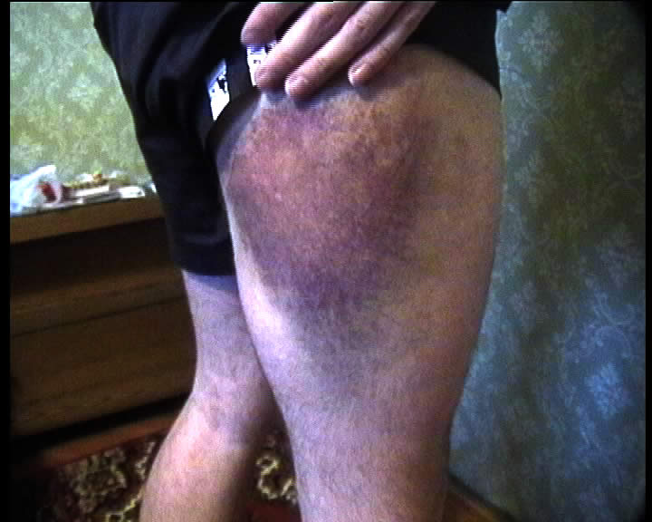 Badly bruised leg
